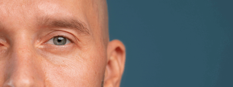 perdida-de-ojo-prótesis-ocular-artlens