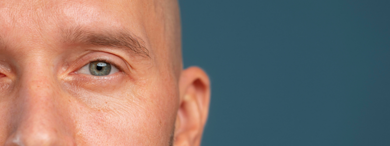 perdida-de-ojo-prótesis-ocular-artlens